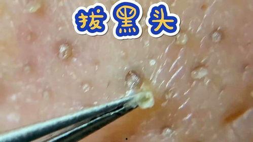 黑头粉刺视频,如何有效清洁与预防
