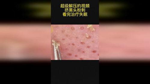 黑头粉刺视频,如何有效清洁与预防