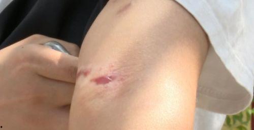 拔罐操作视频,轻松缓解身体不适