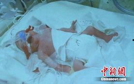 婴儿手术视频,揭秘医疗科技守护幼小心灵