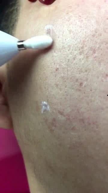 去斑视频,焕发无瑕肌肤——揭秘高效去斑视频教程