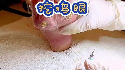 挖瘊子视频,传统民间疗法的现代视角