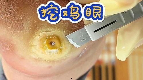 挖瘊子视频,传统民间疗法的现代视角