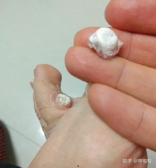 去除鸡眼视频,跟随视频教程学除法