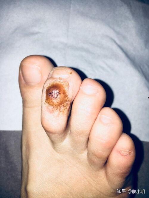 去除鸡眼视频,跟随视频教程学除法