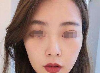 割眼袋视频,跟随割眼袋视频教程，重拾明眸神采