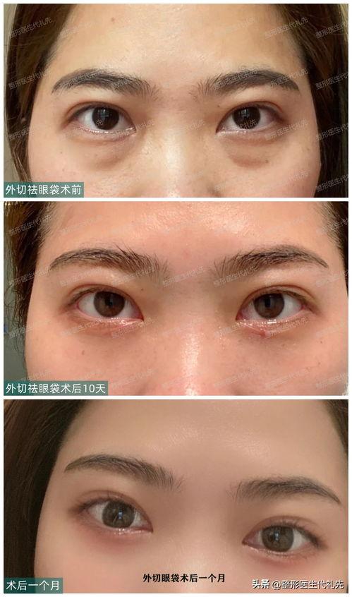 割眼袋视频,跟随割眼袋视频教程，重拾明眸神采