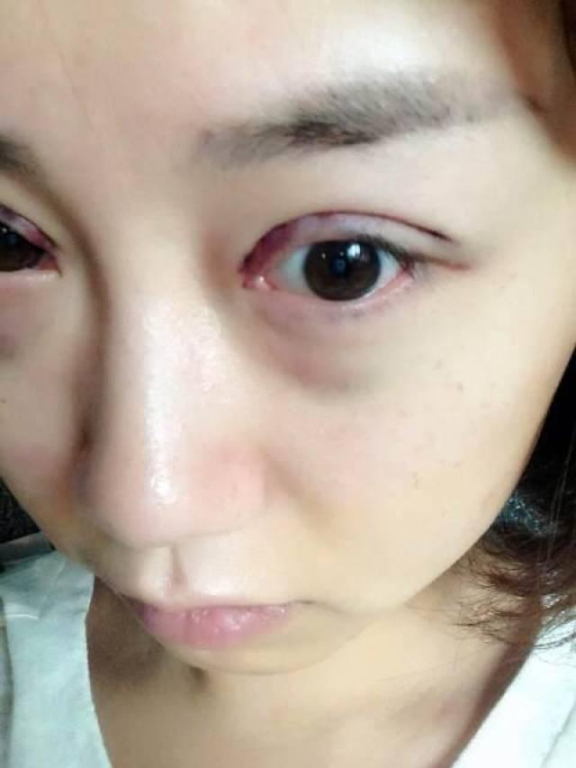 割眼袋视频,跟随割眼袋视频教程，重拾明眸神采