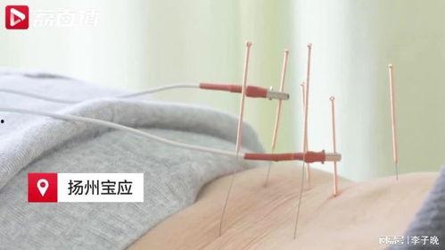 女人针灸视频,女性健康养生的秘密武器