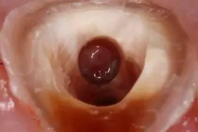 开髓视频,直观展示医学技术的进步